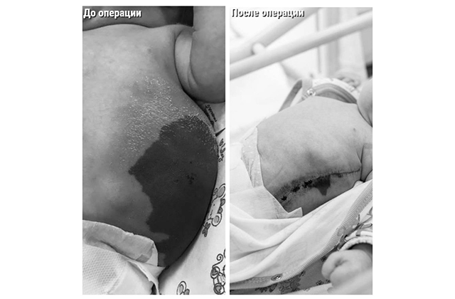 Врачи Щелковского перинатального центра прооперировали новорожденного с 25-сантиметровой лимфангиомой